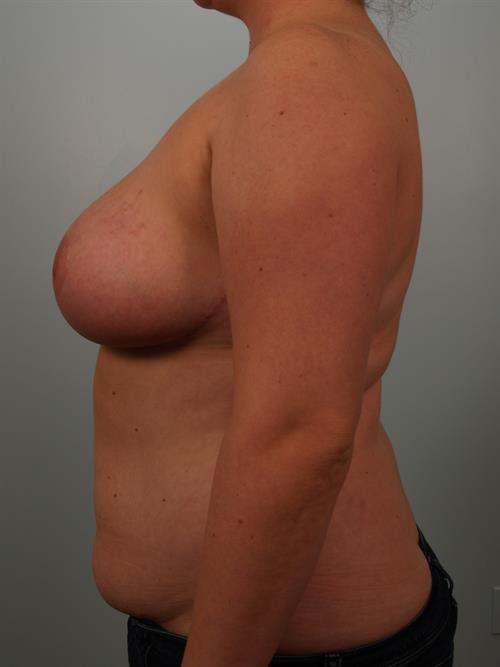 Breast Reduction After Photo | Phoenix and Scottsdale, AZ | Scottsdale Center for Plastic Surgery