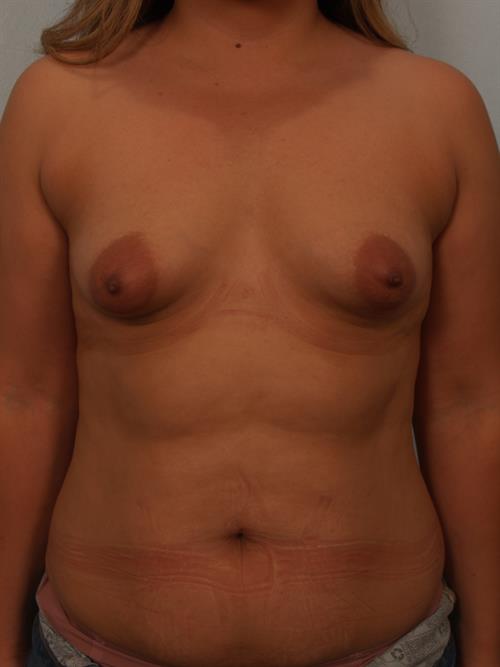 Tuberous Breast Surgery Before Photo | Phoenix and Scottsdale, AZ | Scottsdale Center for Plastic Surgery