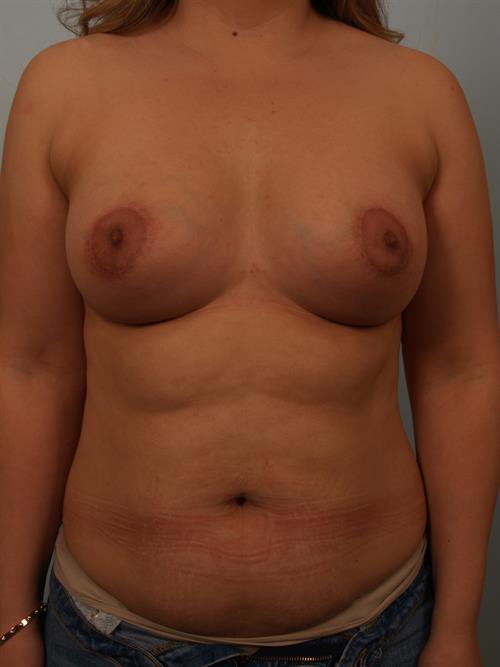 Tuberous Breast Surgery After Photo | Phoenix and Scottsdale, AZ | Scottsdale Center for Plastic Surgery