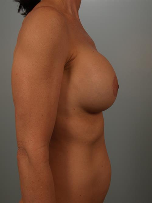 Revision Breast Surgery After Photo | Phoenix and Scottsdale, AZ | Scottsdale Center for Plastic Surgery