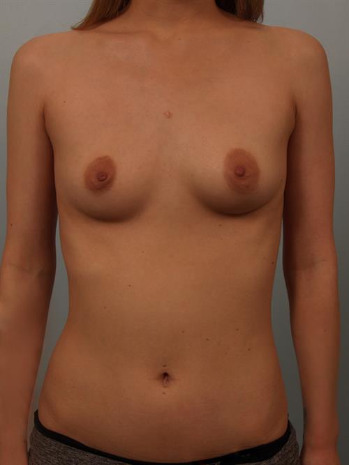 Breast Lift (Mastopexy) Before Photo | Phoenix and Scottsdale, AZ | Scottsdale Center for Plastic Surgery