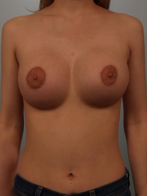 Breast Lift (Mastopexy) After Photo | Phoenix and Scottsdale, AZ | Scottsdale Center for Plastic Surgery