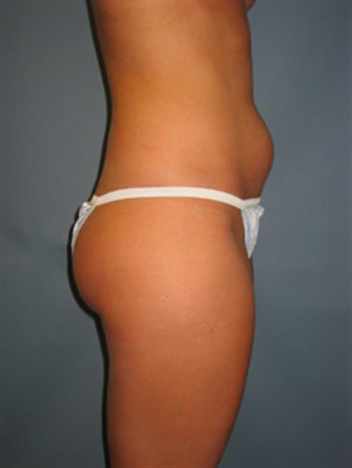 Power Assisted Liposuction Before Photo | Phoenix and Scottsdale, AZ | Scottsdale Center for Plastic Surgery