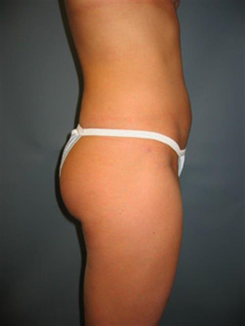 Power Assisted Liposuction After Photo | Phoenix and Scottsdale, AZ | Scottsdale Center for Plastic Surgery