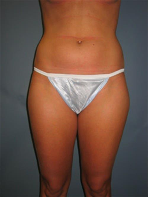 Power Assisted Liposuction Before Photo | Phoenix and Scottsdale, AZ | Scottsdale Center for Plastic Surgery