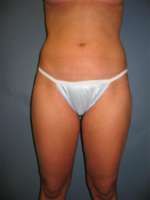 Power Assisted Liposuction After Photo | Phoenix and Scottsdale, AZ | Scottsdale Center for Plastic Surgery
