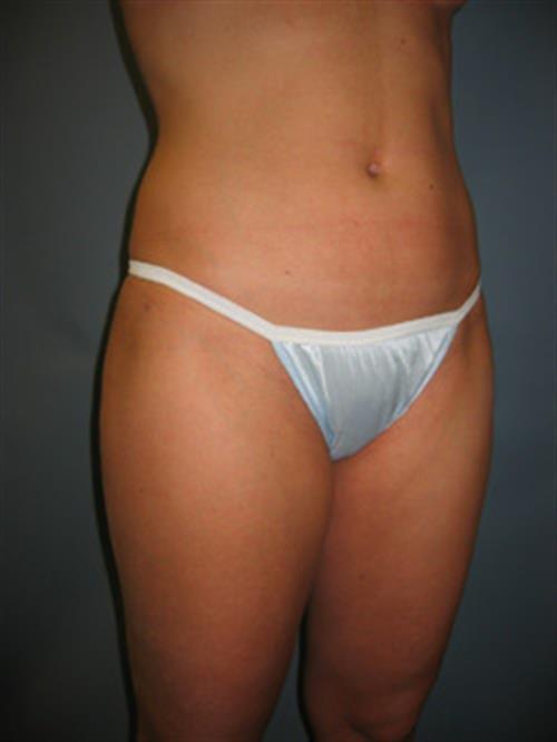 Power Assisted Liposuction After Photo | Phoenix and Scottsdale, AZ | Scottsdale Center for Plastic Surgery