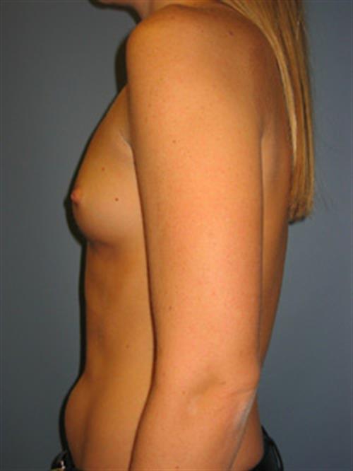 Power Assisted Liposuction Before Photo | Phoenix and Scottsdale, AZ | Scottsdale Center for Plastic Surgery