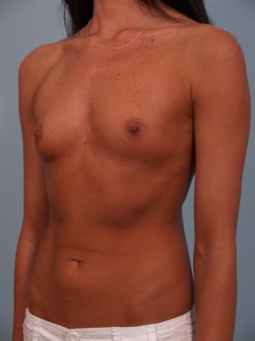 Breast Augmentation Before Photo | Phoenix and Scottsdale, AZ | Scottsdale Center for Plastic Surgery