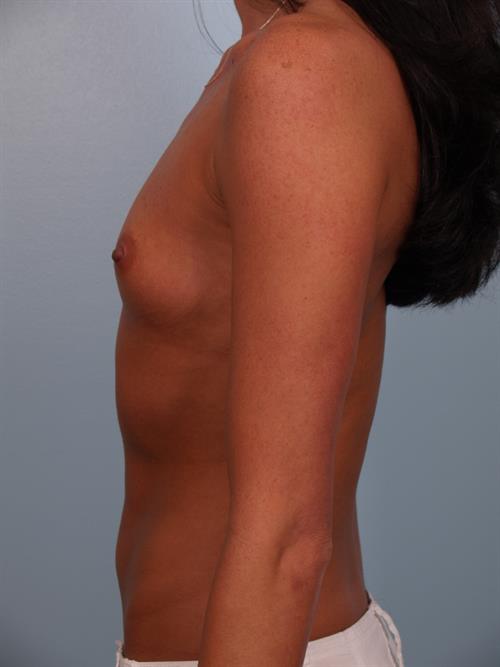 Breast Augmentation Before Photo | Phoenix and Scottsdale, AZ | Scottsdale Center for Plastic Surgery