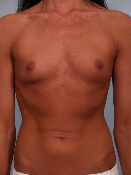 Breast Augmentation Before Photo | Phoenix and Scottsdale, AZ | Scottsdale Center for Plastic Surgery