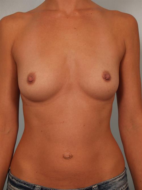 Breast Augmentation Before Photo | Phoenix and Scottsdale, AZ | Scottsdale Center for Plastic Surgery