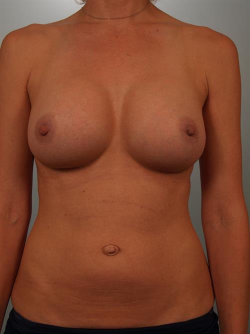 Breast Augmentation After Photo | Phoenix and Scottsdale, AZ | Scottsdale Center for Plastic Surgery