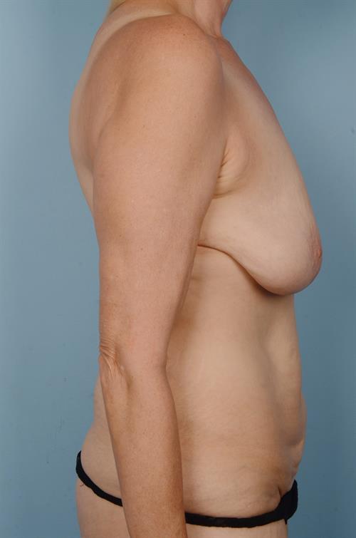 Breast Lift (Mastopexy) Before Photo | Phoenix and Scottsdale, AZ | Scottsdale Center for Plastic Surgery