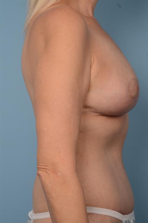 Breast Lift (Mastopexy) After Photo | Phoenix and Scottsdale, AZ | Scottsdale Center for Plastic Surgery