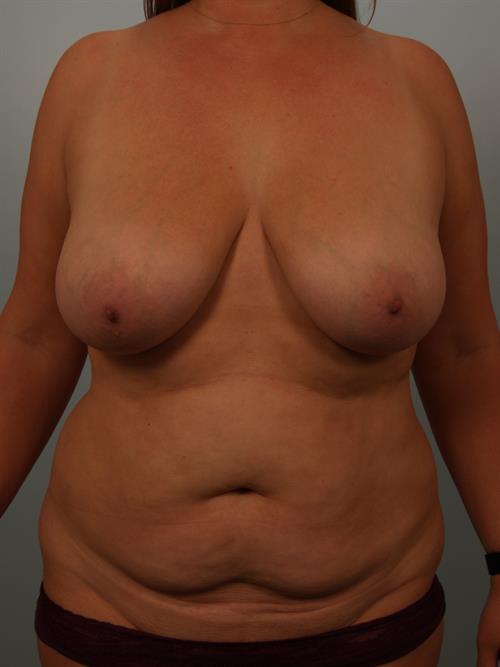 Mommy Makeover Before Photo | Phoenix and Scottsdale, AZ | Scottsdale Center for Plastic Surgery