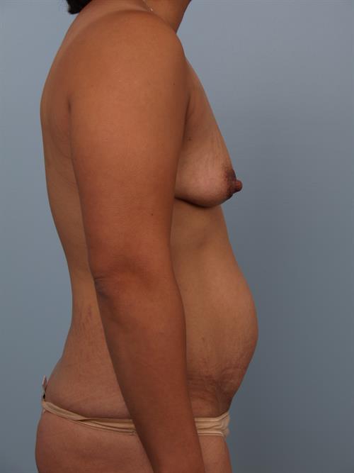 Breast Lift (Mastopexy) Before Photo | Phoenix and Scottsdale, AZ | Scottsdale Center for Plastic Surgery