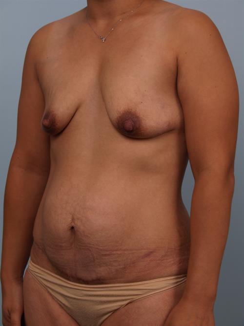 Breast Lift (Mastopexy) Before Photo | Phoenix and Scottsdale, AZ | Scottsdale Center for Plastic Surgery