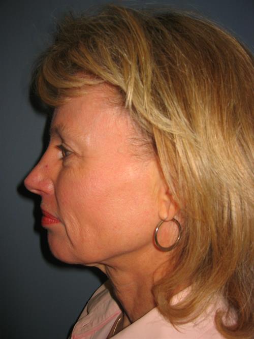 Restylane Before Photo | Phoenix and Scottsdale, AZ | Scottsdale Center for Plastic Surgery