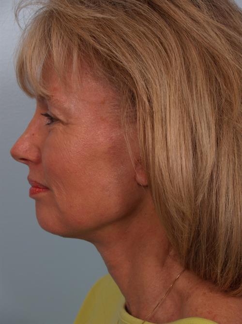 Restylane After Photo | Phoenix and Scottsdale, AZ | Scottsdale Center for Plastic Surgery