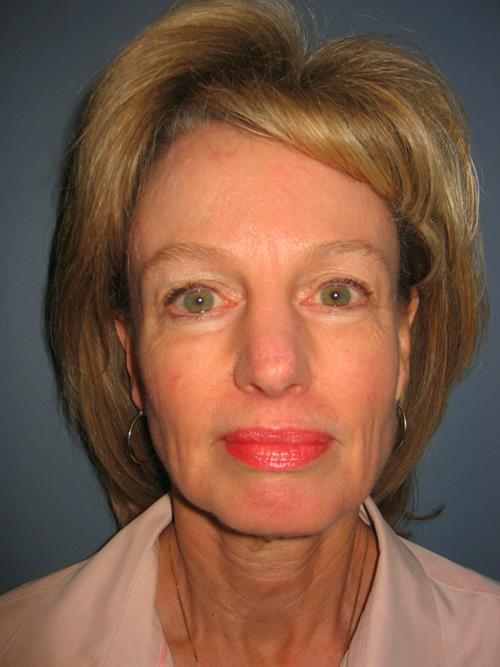 Restylane Before Photo | Phoenix and Scottsdale, AZ | Scottsdale Center for Plastic Surgery