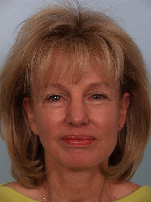 Restylane After Photo | Phoenix and Scottsdale, AZ | Scottsdale Center for Plastic Surgery