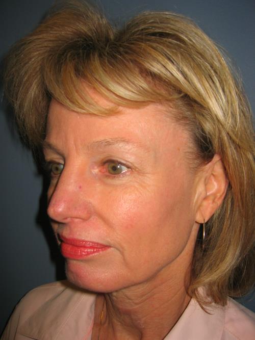 Restylane Before Photo | Phoenix and Scottsdale, AZ | Scottsdale Center for Plastic Surgery