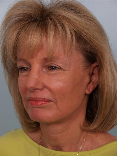 Restylane After Photo | Phoenix and Scottsdale, AZ | Scottsdale Center for Plastic Surgery