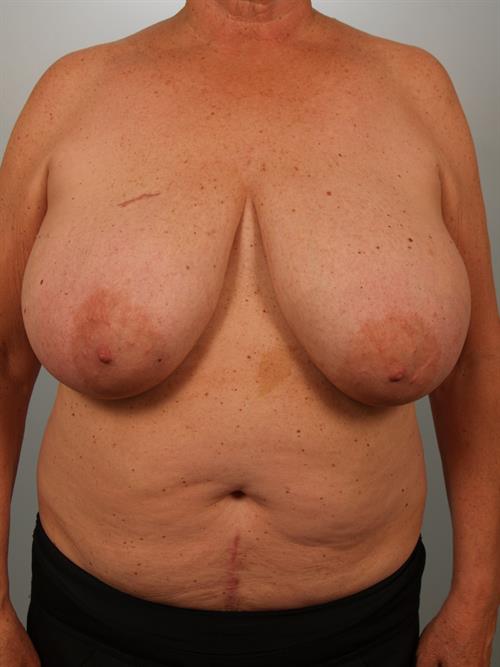 Breast Reduction Before Photo | Phoenix and Scottsdale, AZ | Scottsdale Center for Plastic Surgery