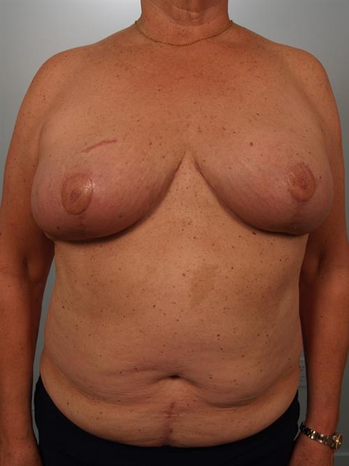 Breast Reduction After Photo | Phoenix and Scottsdale, AZ | Scottsdale Center for Plastic Surgery
