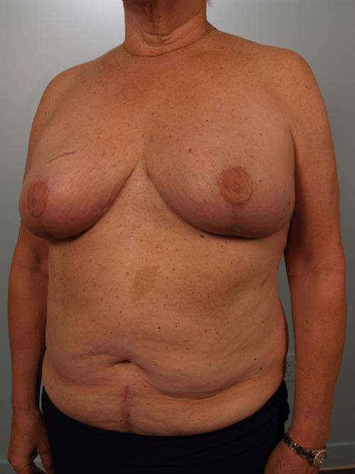 Breast Reduction Before & After Case # 535