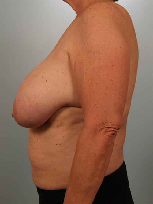 Breast Reduction Before Photo | Phoenix and Scottsdale, AZ | Scottsdale Center for Plastic Surgery
