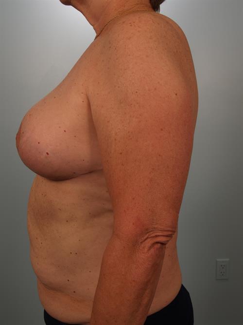 Breast Reduction After Photo | Phoenix and Scottsdale, AZ | Scottsdale Center for Plastic Surgery