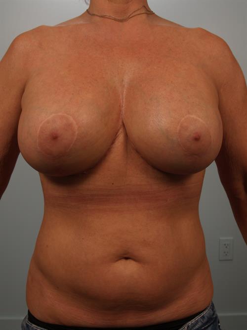 Revision Breast Surgery After Photo | Phoenix and Scottsdale, AZ | Scottsdale Center for Plastic Surgery