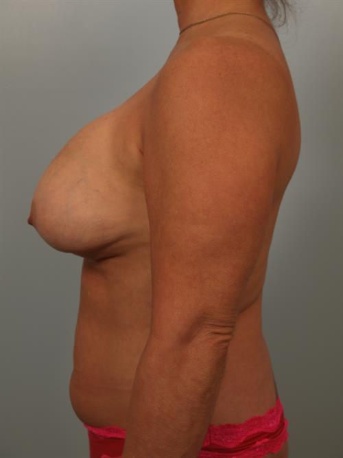 Revision Breast Surgery Before Photo | Phoenix and Scottsdale, AZ | Scottsdale Center for Plastic Surgery