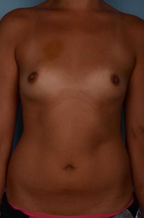 Breast Augmentation Before Photo | Phoenix and Scottsdale, AZ | Scottsdale Center for Plastic Surgery