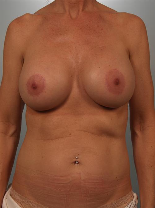 Fat Grafting After Photo | Phoenix and Scottsdale, AZ | Scottsdale Center for Plastic Surgery