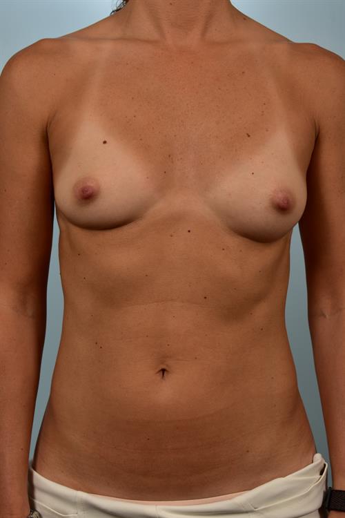 Breast Augmentation Before Photo | Phoenix and Scottsdale, AZ | Scottsdale Center for Plastic Surgery