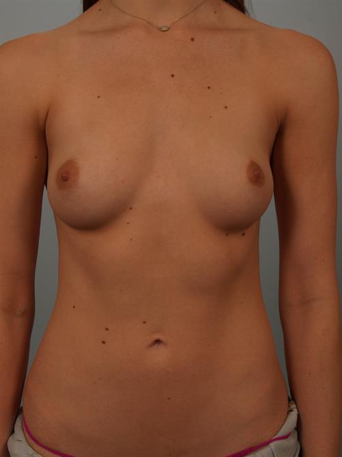 Breast Augmentation Before Photo | Phoenix and Scottsdale, AZ | Scottsdale Center for Plastic Surgery