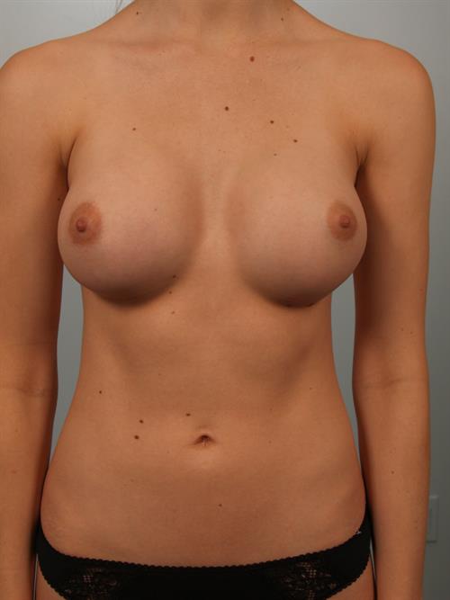 Breast Augmentation After Photo | Phoenix and Scottsdale, AZ | Scottsdale Center for Plastic Surgery
