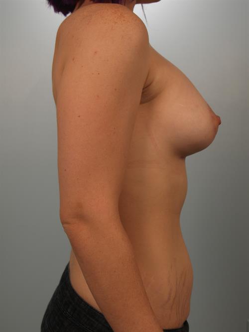 Breast Lift (Mastopexy) After Photo | Phoenix and Scottsdale, AZ | Scottsdale Center for Plastic Surgery