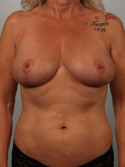 Fat Grafting After Photo | Phoenix and Scottsdale, AZ | Scottsdale Center for Plastic Surgery