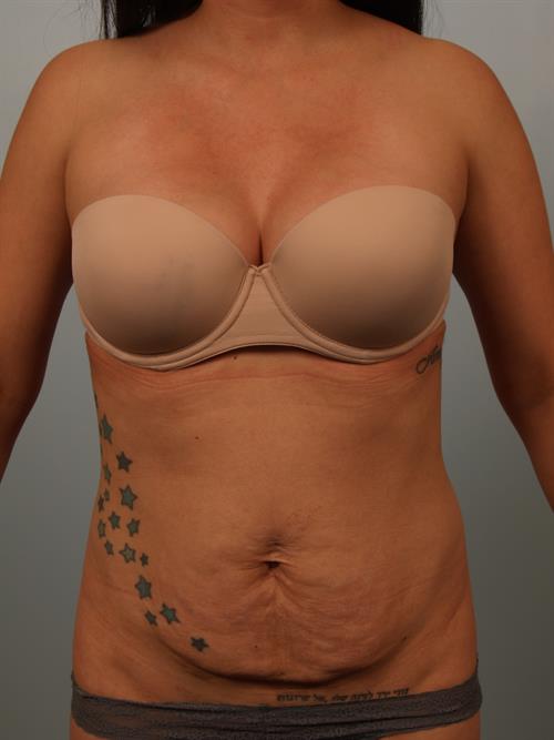 Tummy Tuck Before Photo | Phoenix and Scottsdale, AZ | Scottsdale Center for Plastic Surgery