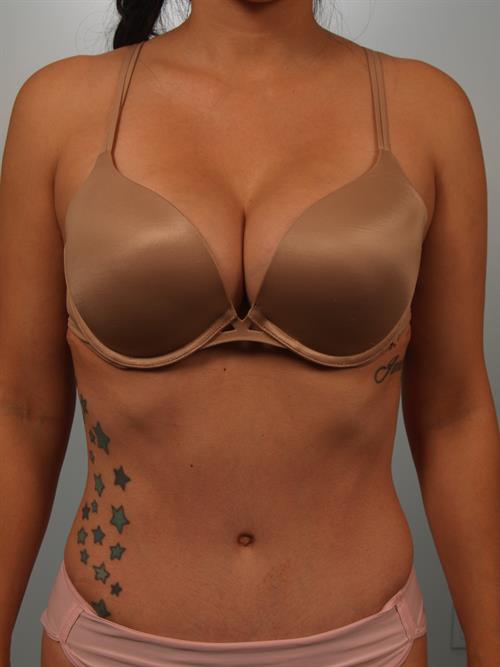 Tummy Tuck After Photo | Phoenix and Scottsdale, AZ | Scottsdale Center for Plastic Surgery