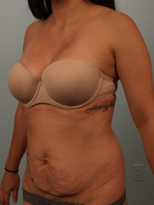 Tummy Tuck Before Photo | Phoenix and Scottsdale, AZ | Scottsdale Center for Plastic Surgery
