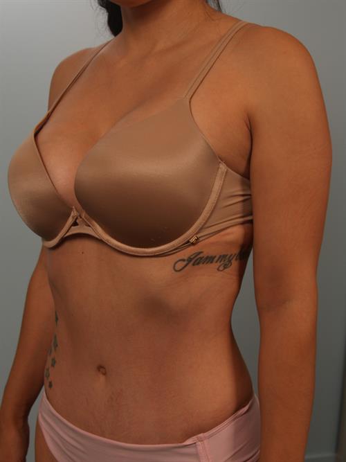 Tummy Tuck After Photo | Phoenix and Scottsdale, AZ | Scottsdale Center for Plastic Surgery