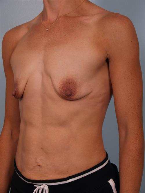 Breast Augmentation Before Photo | Phoenix and Scottsdale, AZ | Scottsdale Center for Plastic Surgery
