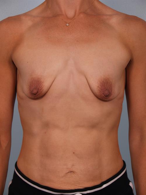 Breast Augmentation Before Photo | Phoenix and Scottsdale, AZ | Scottsdale Center for Plastic Surgery
