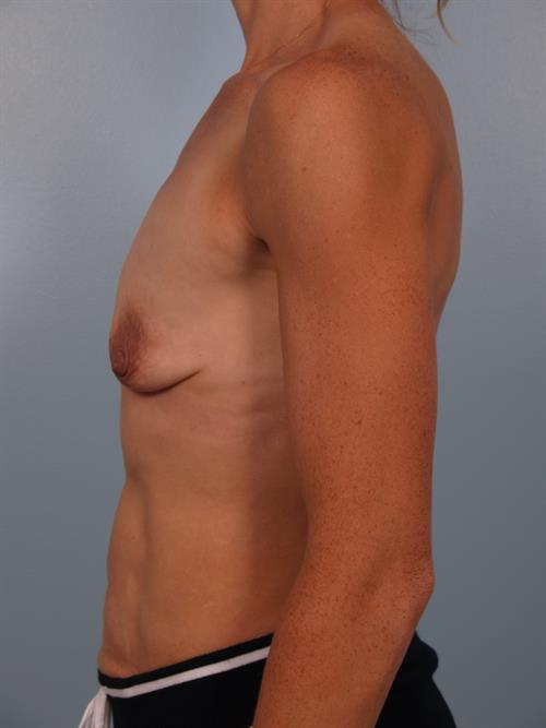 Breast Augmentation Before Photo | Phoenix and Scottsdale, AZ | Scottsdale Center for Plastic Surgery