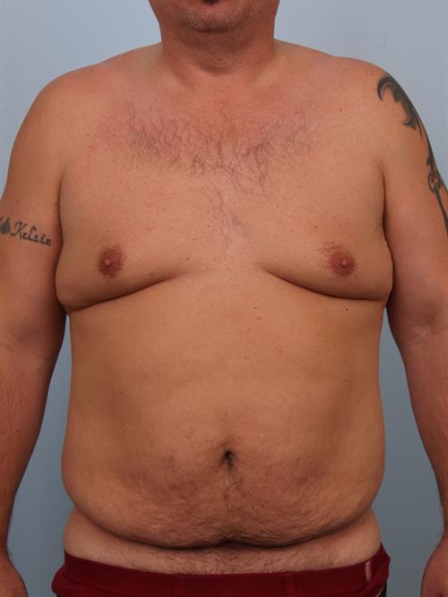 Male Liposuction Before Photo | Phoenix and Scottsdale, AZ | Scottsdale Center for Plastic Surgery